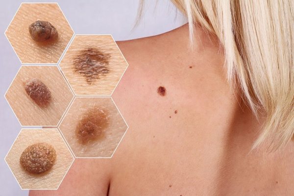 Tia UV ảnh hưởng đến làn da và làm cho da bị ung thư